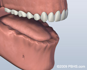Implant Retained Dentures Before